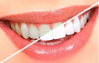 4 mẹo đơn giản giúp bạn sở hữu hàm răng trắng sáng trong 'tích tắc'