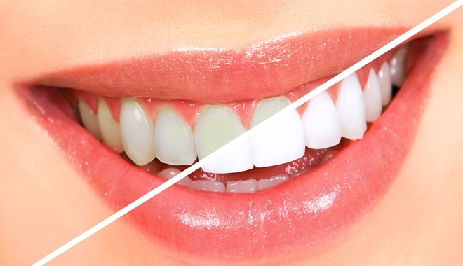 4 mẹo đơn giản giúp bạn sở hữu hàm răng trắng sáng hiệu quả