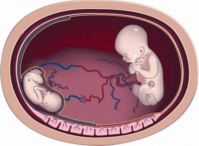 Mắc hội chứng truyền máu song thai khi mang thai đôi, mẹ bầu mất 2 con 2