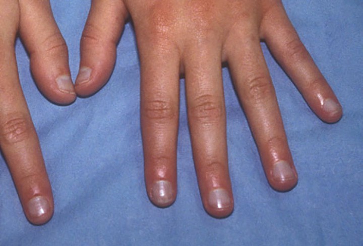 Dấu hiệu bất thường trên móng tay có thể là triệu chứng của bệnh tật
