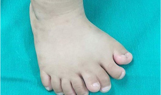 Thanh Hóa: Phẫu thuật thành công cho một bé trai có 9 ngón chân