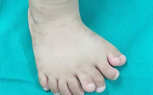 Kỳ lạ một bé trai có tới 9 ngón chân