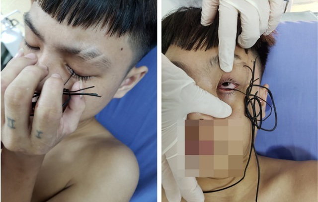 Nam thanh niên bị lõi kim loại của dây điện đâm xuyên mi mắt