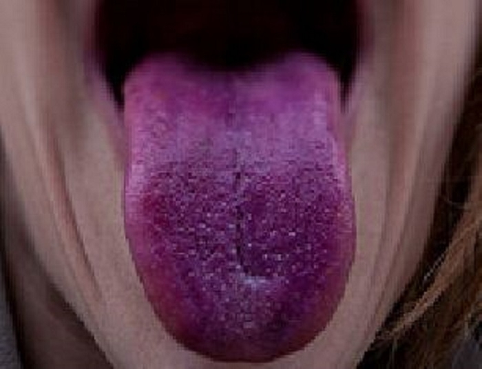 6 dấu hiệu bất thường trên lưỡi cảnh báo những căn bệnh nguy hiểm