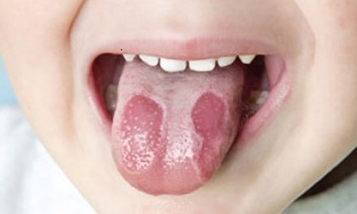 6 dấu hiệu bất thường trên lưỡi cảnh báo những căn bệnh nguy hiểm