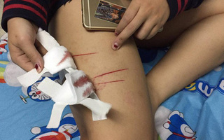 Nữ sinh 17 tuổi ở TP.HCM bị kẻ lạ rạch đùi khi đi học về