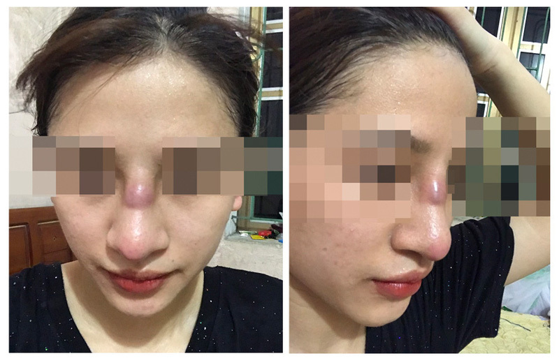 Cô gái 19 tuổi suýt mất mũi sau sau phẫu thuật nâng mũi bằng phương pháp đặt sụn silicon tại spa