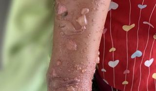 Bé gái 8 tuổi nhập viện do tiếp xúc với nọc độc sứa biển