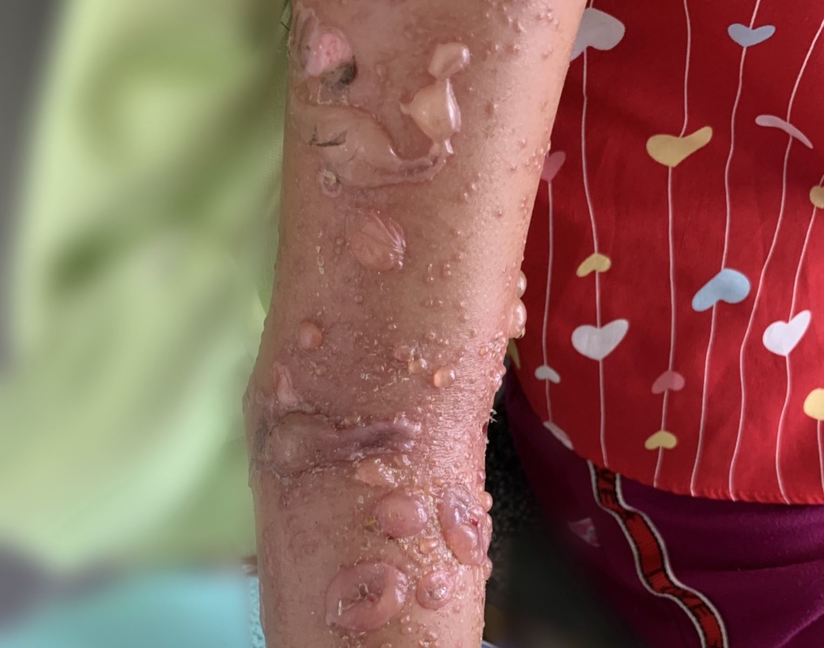 bé gái 8 tuổi nhập viện do tiếp xúc nọc độc sứa biển
