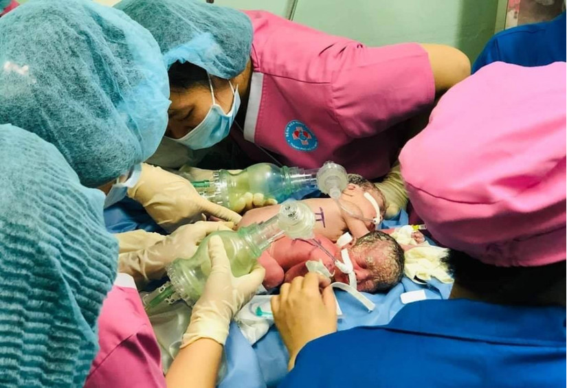 Những hình ảnh cực đáng yêu của hai bé song sinh dính liền trước ca phẫu thuật