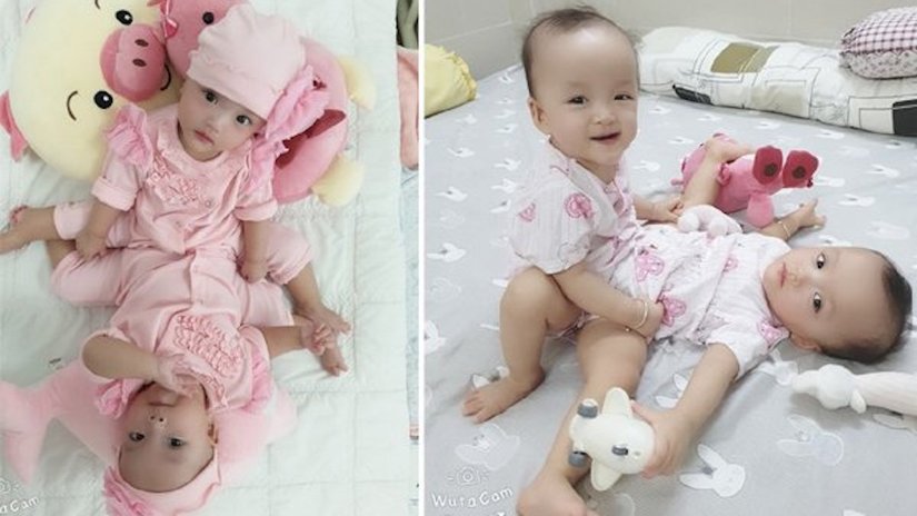 Những hình ảnh cực đáng yêu của hai bé song sinh dính liền trước ca phẫu thuật