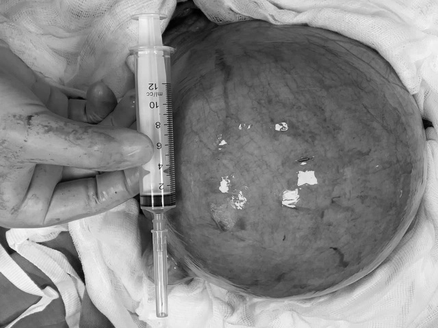 Khối u xơ tử cung nặng 2,5kg nằm trong bụng người phụ nữ