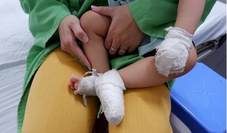 Trẻ em nhập viện do tai nạn bỏng tăng đột biến