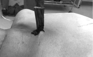 Người đàn ông nguy kịch do bị thanh gỗ đâm xuyên ngực