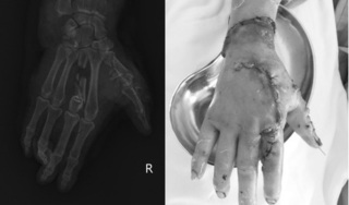 Người phụ nữ bị dập nát bàn tay sau khi sử dụng máy xay đá tại nhà