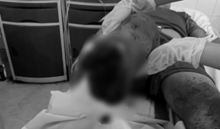 Thiếu niên 15 tuổi bị chém đứt lìa chân sau cuộc hỗn chiến