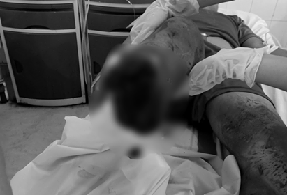 Thiếu niên 15 tuổi bị chém đứt lìa chân sau cuộc hỗn chiến