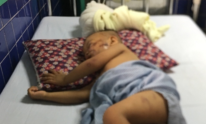 Bé trai 2 tuổi ở Quảng Bình bị chó becgie 38kg cắn nát mặt