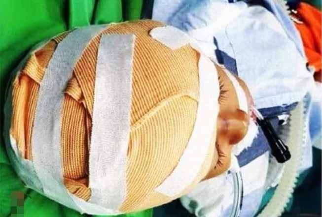 Cháu bé 5 tuổi ở Nghệ An bị chó cắn gây thương tích nặng ở vùng đầu và mặt