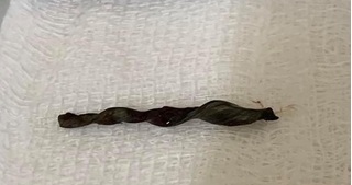 Trong lúc cắt cỏ, người đàn ông bị mẩu sắt dài 3,5cm đâm thủng ruột