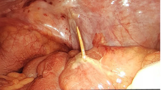 Người đàn ông bị đâm thủng ruột do nuốt phải que tăm nhọn hoắt