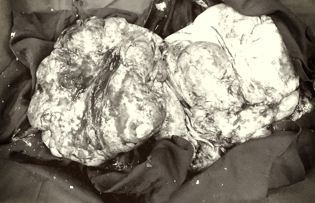 Người phụ nữ mang trong mình khối u buồng trứng nặng 18kg