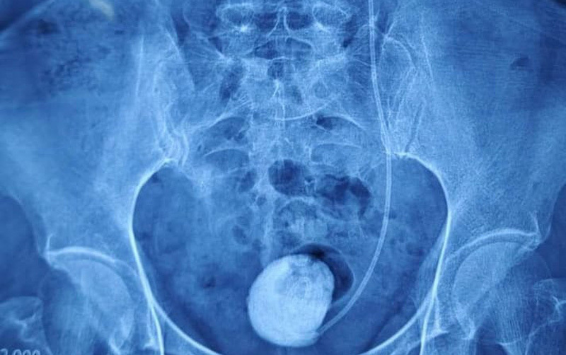 Ống dẫn nước tiểu bị bỏ quên suốt 4 năm trong cơ thể người phụ nữ