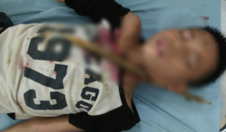 Bé trai 12 tuổi bị cành cây đâm xuyên cổ sau khi ngã từ trên cao xuống