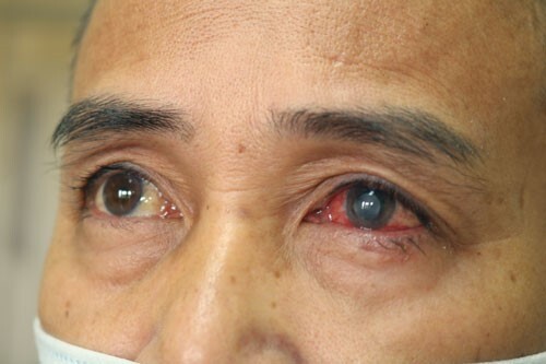 Người đàn ông suýt mù mắt do bị mảnh vôi vữa bắn vào