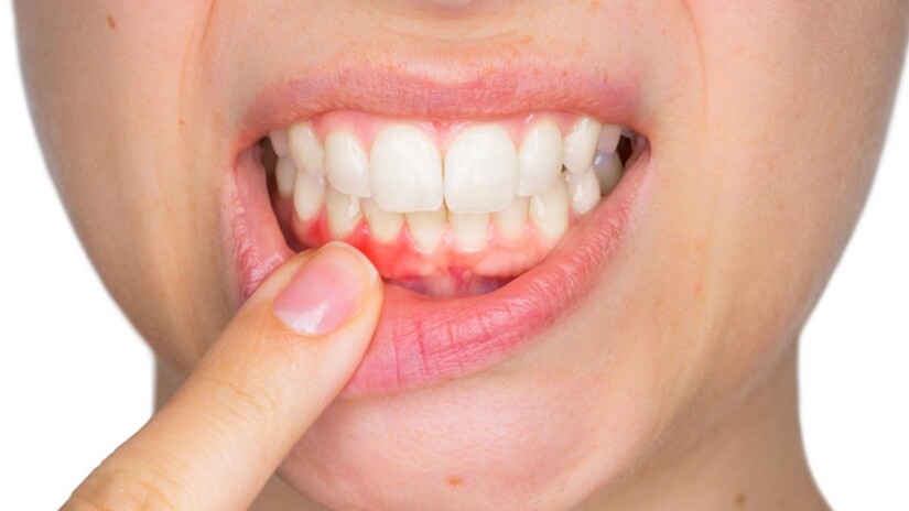Những vấn đề về răng miệng tố cáo sức khỏe bạn đang có vấn đề