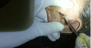 Ổ giòi 30 con sống trong tai cụ bà 88 tuổi