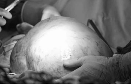 Khối u buồng trứng nặng 11kg nằm gọn trong ổ bụng cô gái trẻ