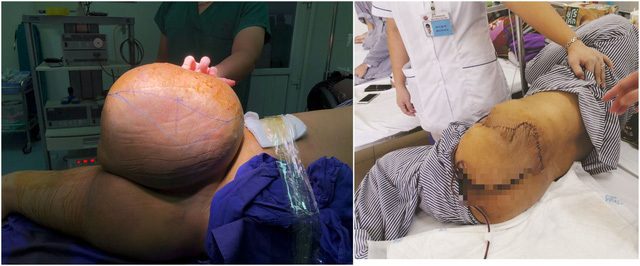 12 lần phẫu thuật cắt bỏ khối u thần kinh kích thước khủng ra khỏi cơ thể người đàn ông