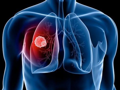 Các triệu chứng giúp bạn nhận biết sớm bệnh ung thư phổi