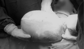 Sản phụ sinh đôi, một bé còn nguyên trong túi ối gây ngạc nhiên