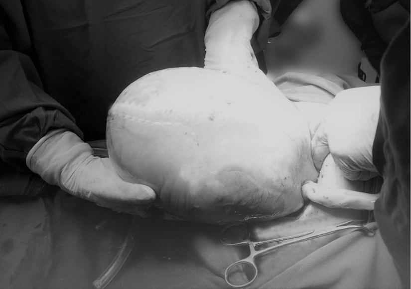 Một bé trong ca song sinh còn nguyên trong bọc ối lúc chào đời