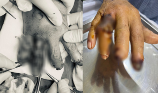 Bàn tay phải người đàn ông dập nát do bị cuốn vào máy cắt than