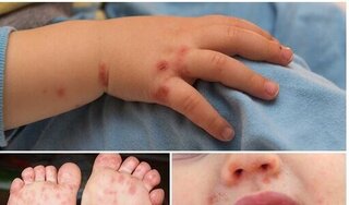 Hà Nội: Số trẻ mắc tay chân miệng tăng nhanh, nhiều trường hợp nặng