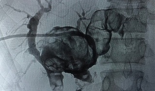 Đi khám vì đau bụng, người phụ nữ phát hiện sỏi đúc khuôn đầy trong gan