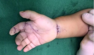 Bé 1 tuổi cầm phải sâu róm, tay bị viêm thành ổ mủ do cách chữa sai lầm của bố mẹ