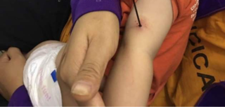 Bé gái 6 tháng tuổi bị nan ô đâm xuyên cánh tay