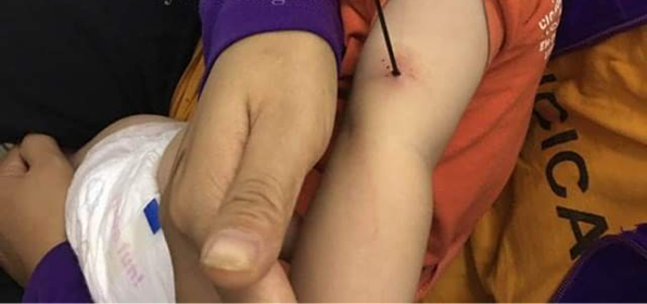 Bé gái 6 tháng tuổi bị nan ô đâm xuyên cánh tay trong lúc chơi đùa cùng anh trai