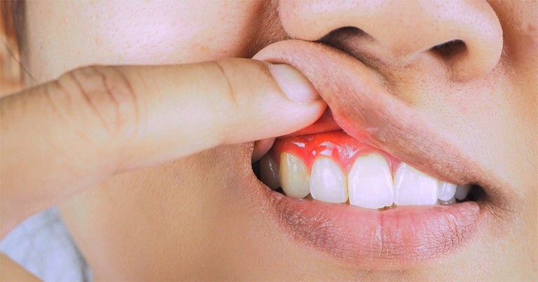 đau răng sưng lợi