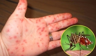 Hơn 3.700 ca mắc sốt xuất huyết được ghi nhận tại Hà Nội