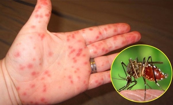 Hơn 3.700 ca mắc sốt xuất huyết được ghi nhận tại Hà Nội