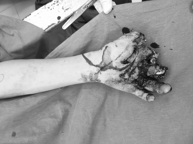 Pin quạt tích điện phát nổ, thiếu niên 14 tuổi bị dập nát bàn tay