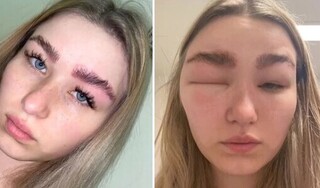 Cô gái bị dị ứng, sưng phù mặt sau khi đi duỗi lông mày