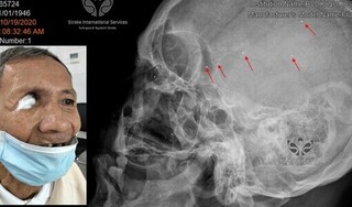 Hàng trăm mảnh đạn li ti nằm trong đầu người đàn ông