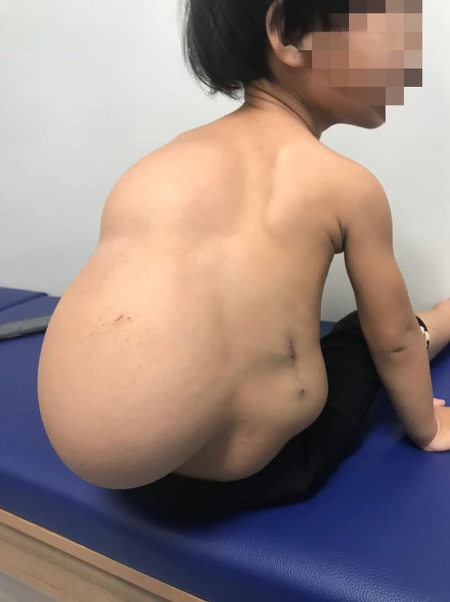 Bé gái 2 tuổi mang trong mình khối u mỡ khổng lồ nặng 4 kg