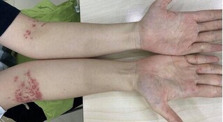 Tưởng bị bệnh chàm, đi khám phát hiện mắc bệnh tay chân miệng